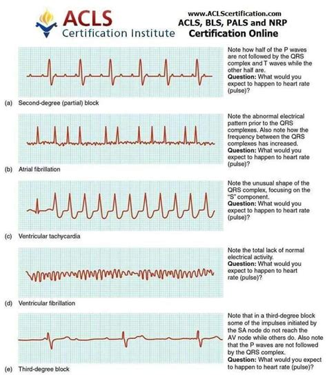 ekg strips nursing mnemonics nursing school nurse