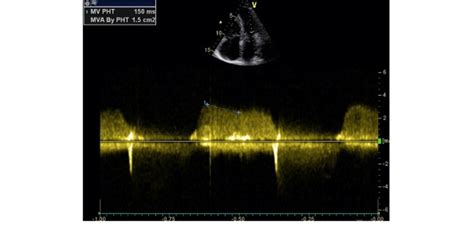 Continuous Wave Doppler Showing Moderate Mitral Stenosis