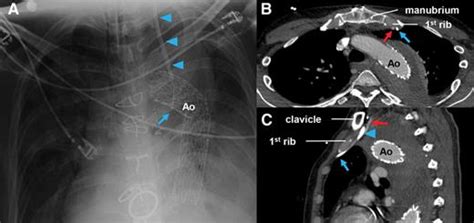 central venous catheter in the internal mammary vein anesthesiology