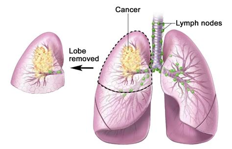 stage   small cell lung cancer life expectancy canceroz