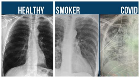 dr oz highlights the difference in scans between healthy lungs