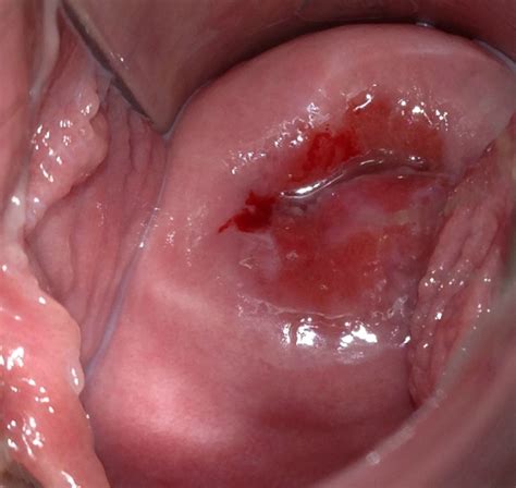 inside vagina hymen