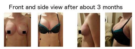 breast pump enlargement results