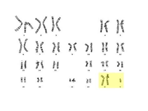 sex chromosomes and abnormalities sex chromosomes at the