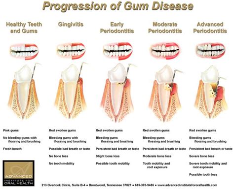 gum disease gingivitis  risk factors symptoms  treatment
