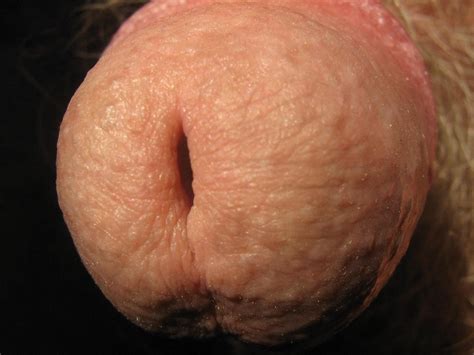 meatus of the penis