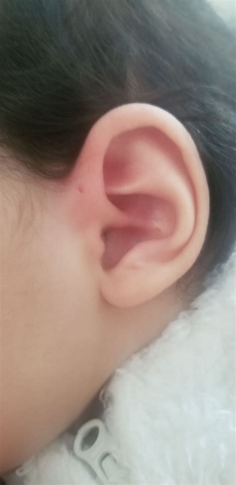 ear pit babycenter
