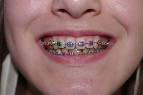 97 best colors braces images on pinterest braces for
