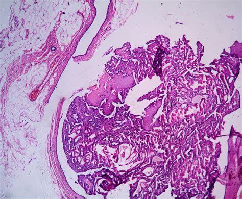 papillary lesions histopathologyguru