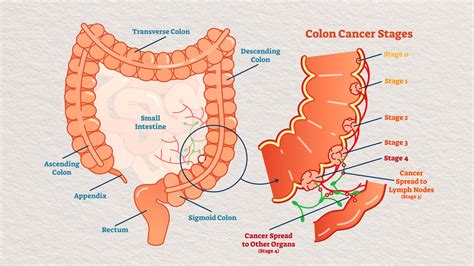 Colon Cancer Stages What Do They Mean For Survival Everyday Health