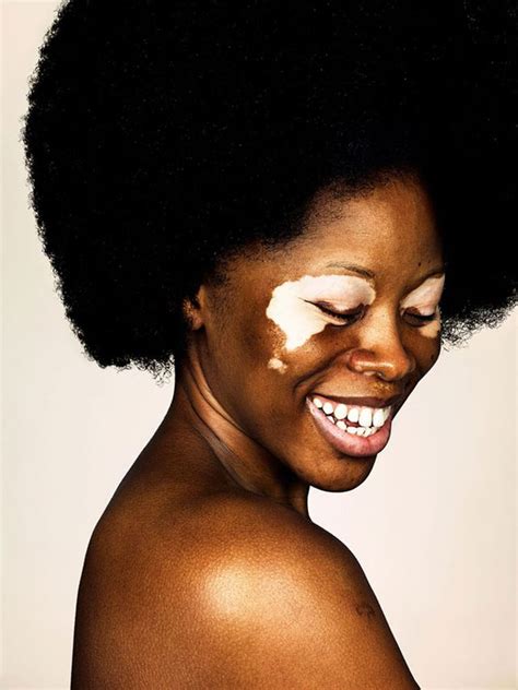 kijk even naar deze adembenemende vitiligo fotoserie enfait