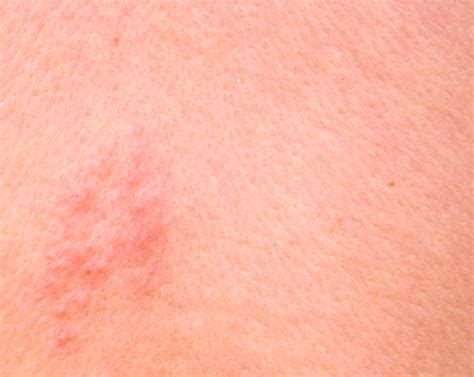 shingles rash pictures sexy fucking images