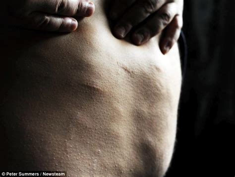 Dercums Disease Sufferer Whos Covered In Hundreds Of Balls Of Fat
