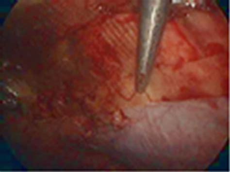 Laparoscopic Hernioplasty Using Omega 3 Coating Mesh