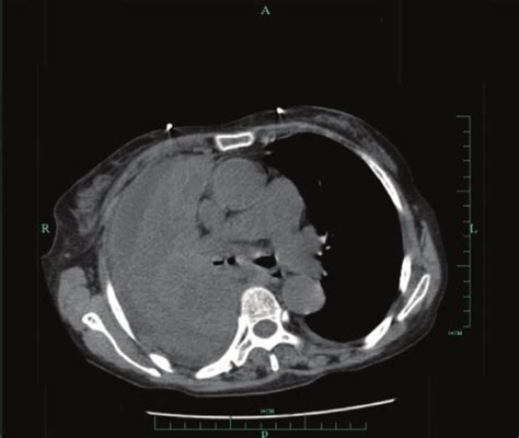 Chest Ct Scan Showing Right Hilar Soft Tissue Mass Associated With