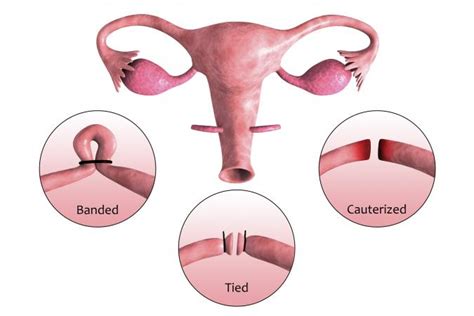 the odds of getting pregnant after your tubes are tied lovetoknow