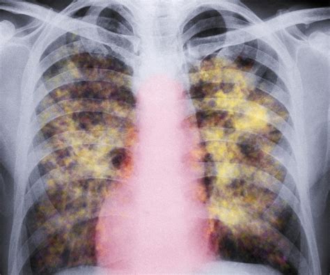 lawmakers seek protections  workers  lung damage tied