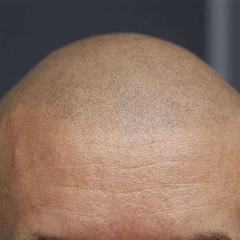 precision scalp scalp micropigmentation