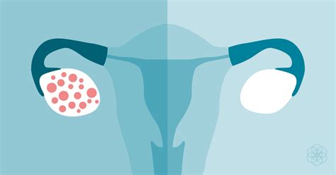 Conceptos Básicos Sobre El Síndrome De Ovario Poliquístico Sop