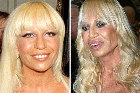 Donatella Versace Before And After Plastic Surgery 1