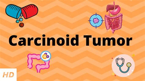 Carcinoid Tumor Causes Signs And Symptoms Diagnosis And Treatment
