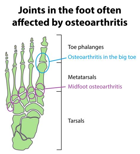 osteoarthritis   ankle  foot buxton osteopathy clinic