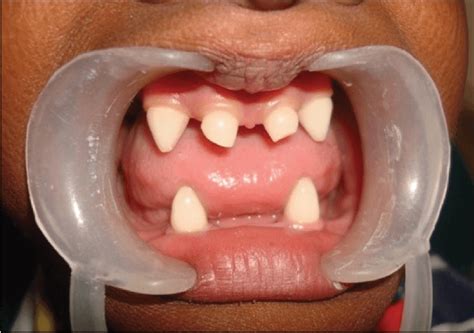 What Is The Difference Between Hyperdontia Hypodontia Oligodontia And