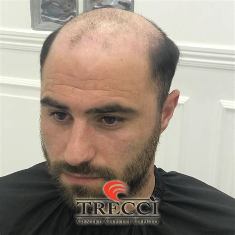 L'infoltimento capelli non chirurgico comprende una serie di diverse metodiche. Protesi di capelli a Napoli, protesi capillare ed impianti di capelli a