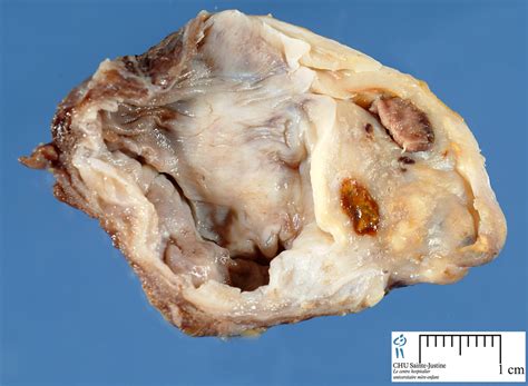 Ovarian Cystadenomas Human Pathology