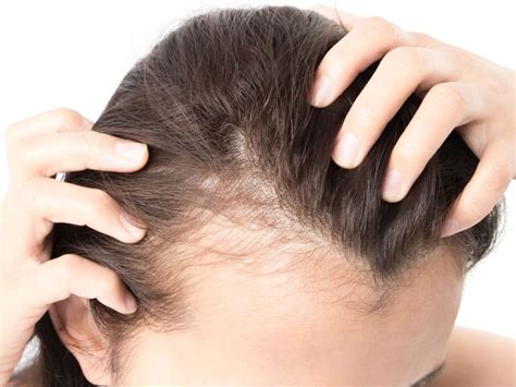 receding hairline  women signs  reversal surgery hair