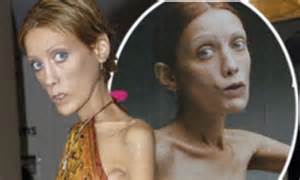 Guilty Mother Of Dead Anorexic Model Isabelle Caro Commits Suicide