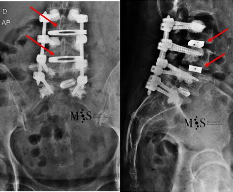 oblique lateral lumbar interbody fusion olif morgenstern institute  spine