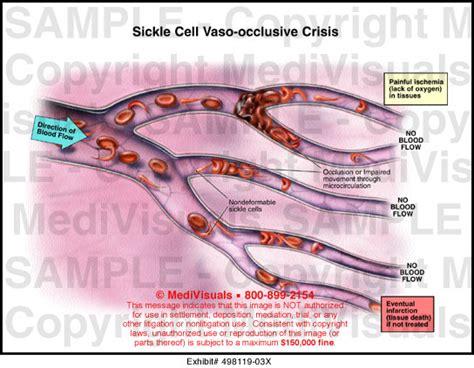 Medivisuals Sickle Cell Vaso Occlusive Crisis Medical Illustration