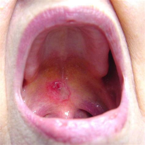 picture of aphthous ulcer of the soft palate