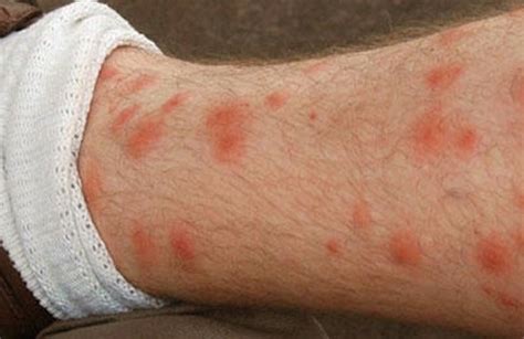 red spots  legs itchy pictures dots patches blotches  images