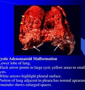 Image result for Zystisch adenomatoide malformation der Lunge. Size: 175 x 185. Source: www.slideserve.com