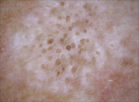 dermoscopy of extragenital lichen sclerosus dermatology jama