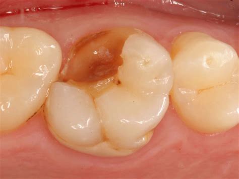 bellevue family dentistry oral health blog broken tooth  biting