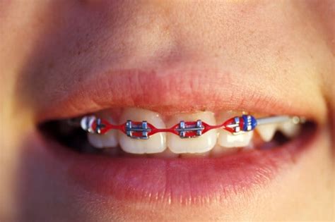 wear rubber bands   braces king orthodontics