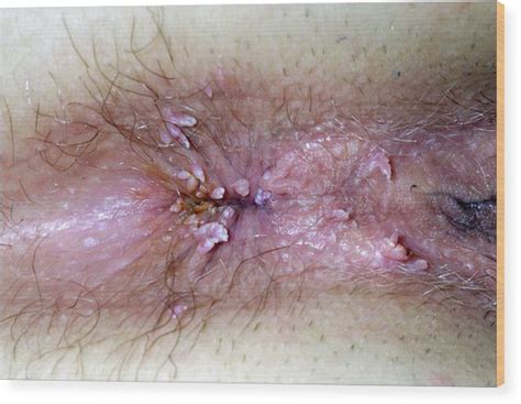 genital warts photograph by dr p marazzi science photo library