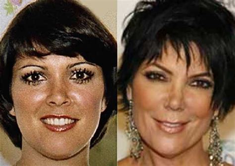 How Real Are The Kardashians Kris Jenner Plastic Surgery Exegesis