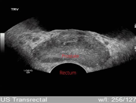 cureus effectiveness of virchow s node fine needle biopsy for the