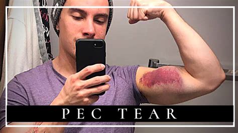 recovered  pec tear surgery    months youtube
