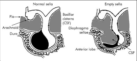 empty sella syndrome semantic scholar