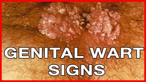 how to recognize genital warts signs youtube