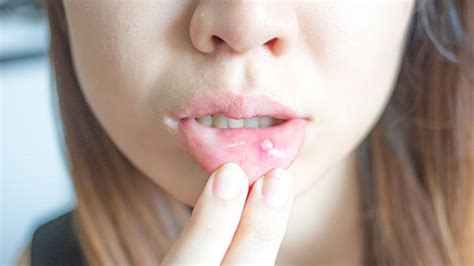 Canker Sore Symptoms And Diagnosis Everyday Health
