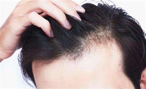 hairfall in men v plant advanced hair care clinics male pattern