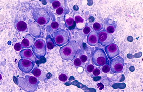 promising  treatment emerges  multiple myeloma