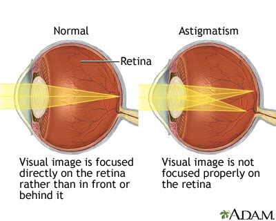 astigmatism information mount sinai  york