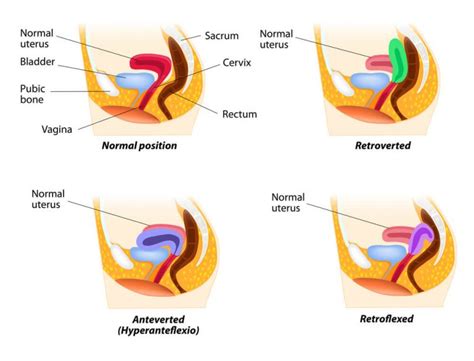 A Useful Guide To Retroverted Uterus